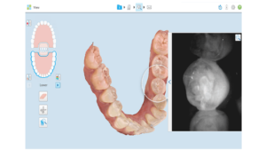 iTero NIRI technology, an interproximal caries detection tool you can trust. An article from a 2021 clinical study validating the significant benefits of the iTero Element 5D imaging systems as an aid in detection and monitoring of interproximal caries