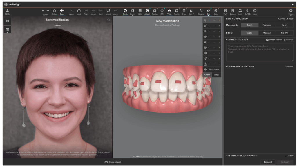 ALIGN TECHNOLOGY INTRODUCES INVISALIGN® SYSTEM INNOVATION FOR GREATER CONTROL OF DIGITAL TREATMENT PLANNING WITH INTEGRATION OF PLAN EDITOR INTO CLINCHECK® TREATMENT PLANNING SOFTWARE