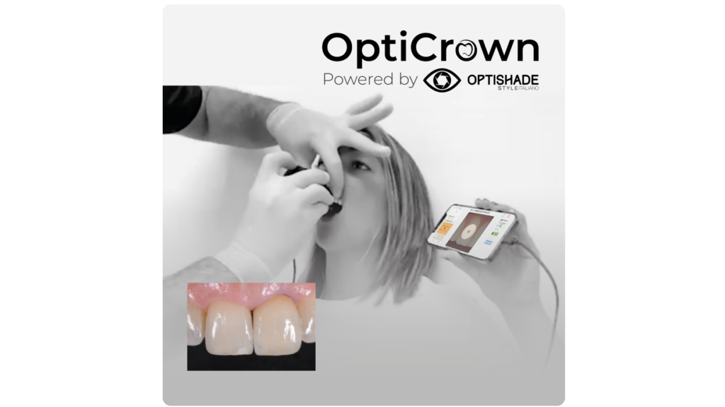 OptiCrown