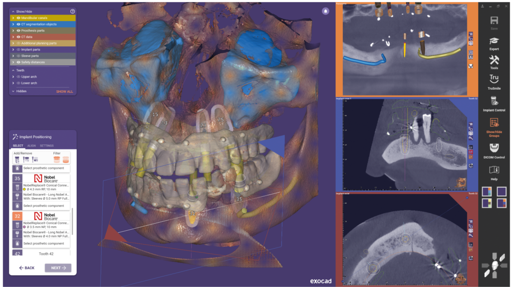Exoplan implant planning