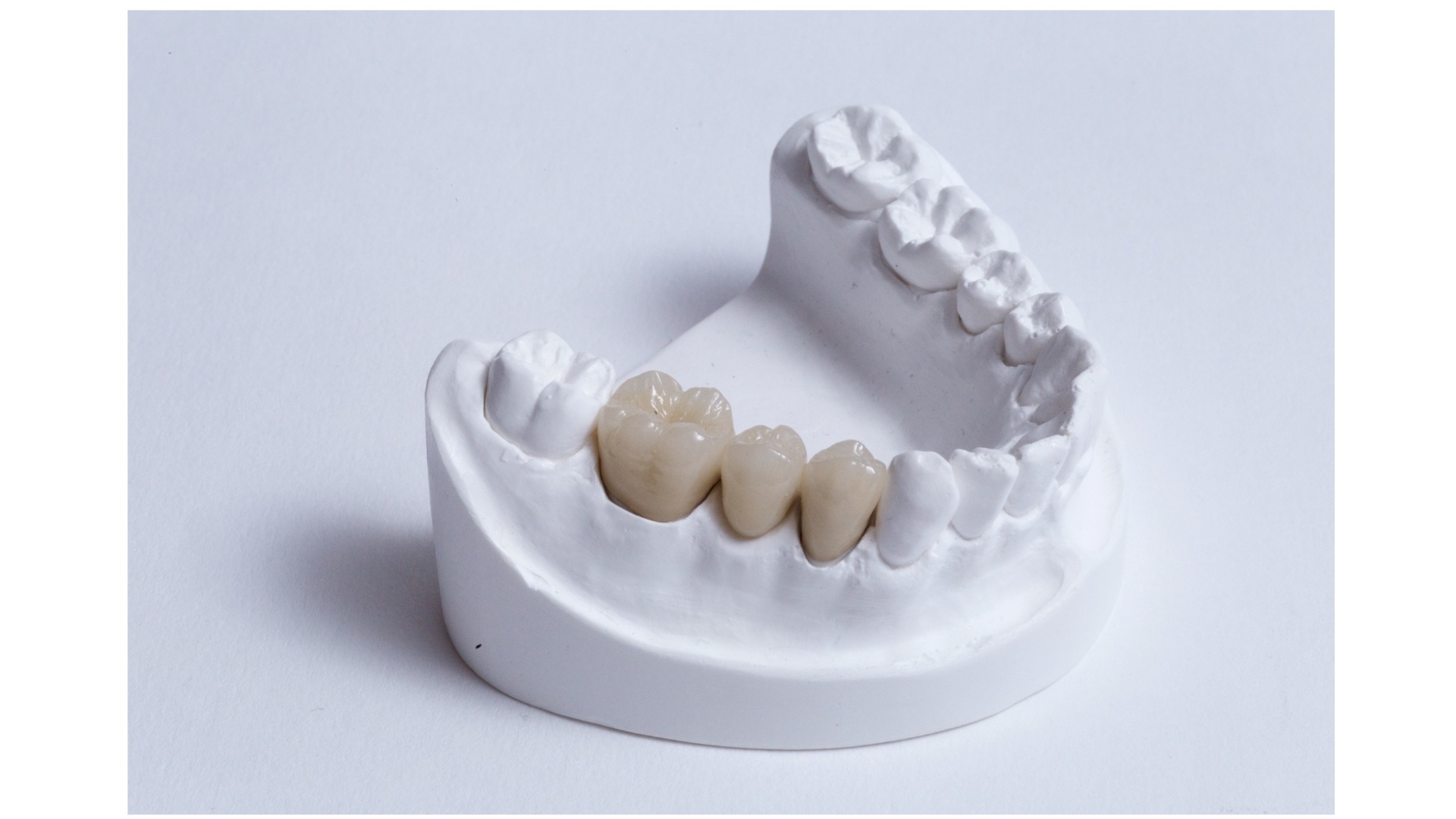 BRIDGE CCM CERAMO METALIQUE