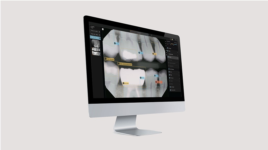 Second Opinion: La première Intelligence Artificielle qui vous aide en temps réel à votre évaluation radiographique.