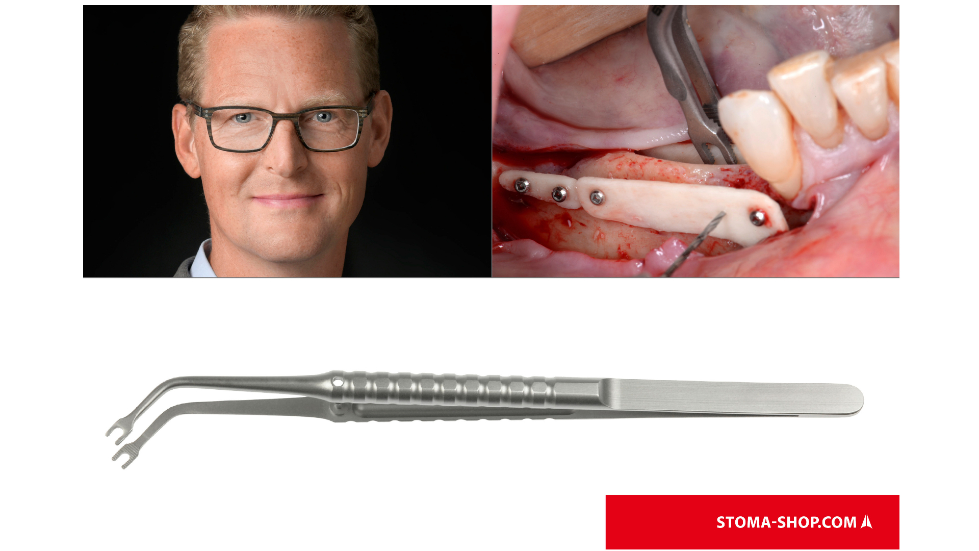 Précelle pour tenir des greffons osseux selon le Docteur Tunkel