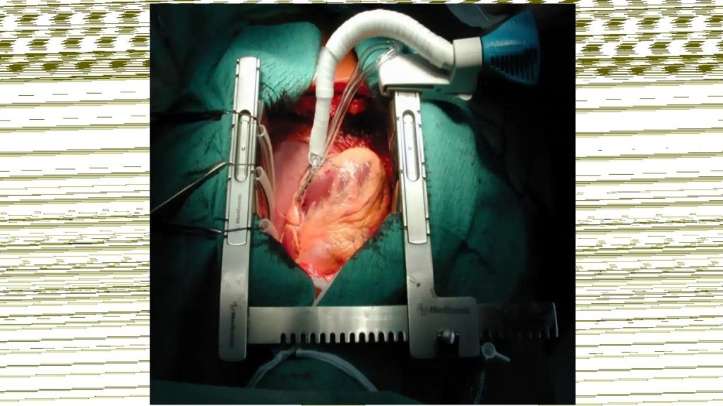 30 ans de chirurgie cardiaque et toujours plus de patients opérés à la Clinique Saint-Luc Bouge