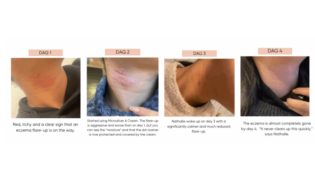 Natural treatment for Atopic Excema