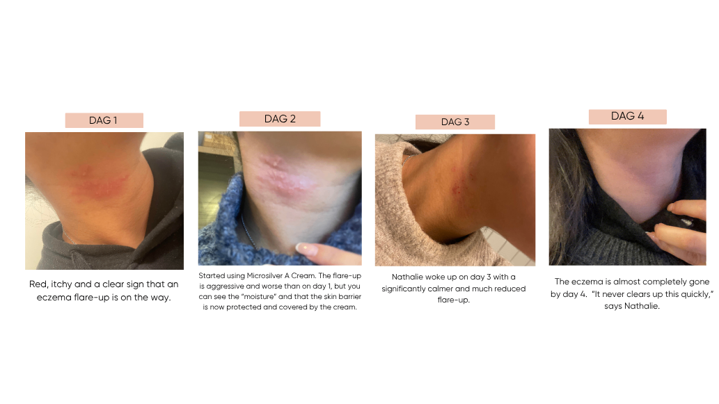 Natural treatment for Atopic Excema